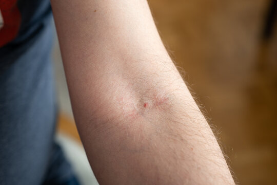 Small mark left by the needle on the elbow pit of a Caucasian male arm. Close up shot, unrecognizable person.