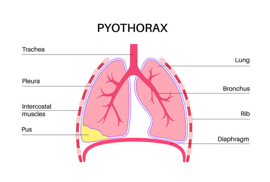 Pyothorax pleural empyema