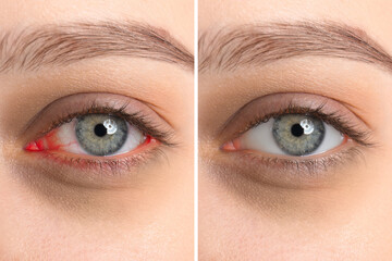 Collage with photos of woman before and after conjunctivitis treatment, closeup of eye