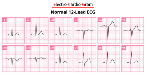 The Differences in Normal ECG Waveform for Each of the 12 Leads Standard ECG - Medical Vectors and Illustrations for Medical Purposes