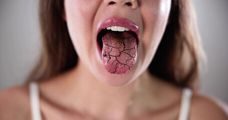 Dry Tongue Pain And Cracks