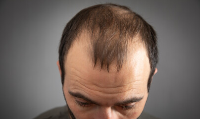 Obraz premium Caucasian man. Hair loss problem