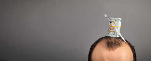Caucasian man with a syringe and money. Money for hair transplantation. Hair loss problem