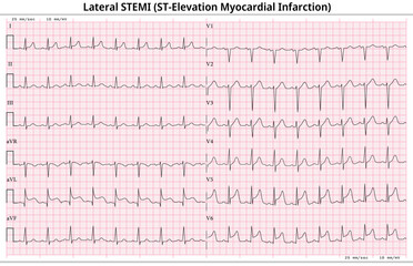 Lateral ST-Elevation Myocardial Infarction (STEMI) - 12 Lead ECG Common Case - 6 Sec/lead - Vectors and Illustration for Medical Purposes