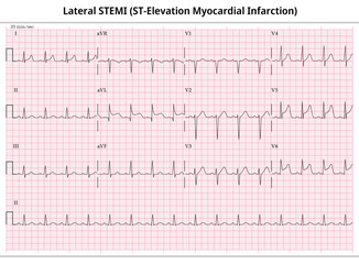 Lateral ST-Elevation Myocardial Infarction (STEMI) - 12 Lead ECG Common Case - 3 Sec/lead - Vectors and Illustration for Medical Purposes - obrazy, fototapety, plakaty