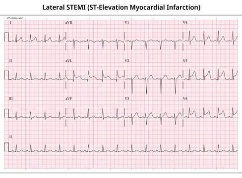 St Elevation Mi