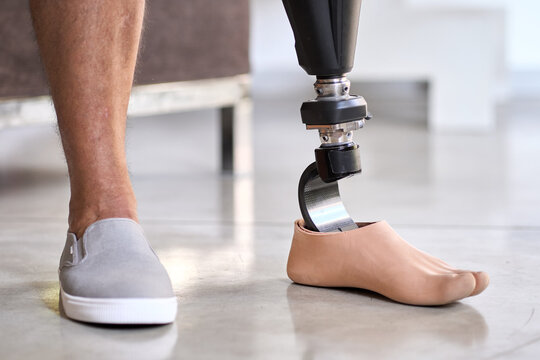 Man amputee with prosthetic leg disability on above knee transfemoral leg prosthesis artificial device stands on feet on floor, close up. People with amputation disabilities everyday life.