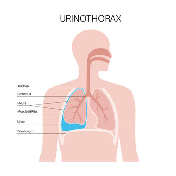 Urinothorax anatomical poster