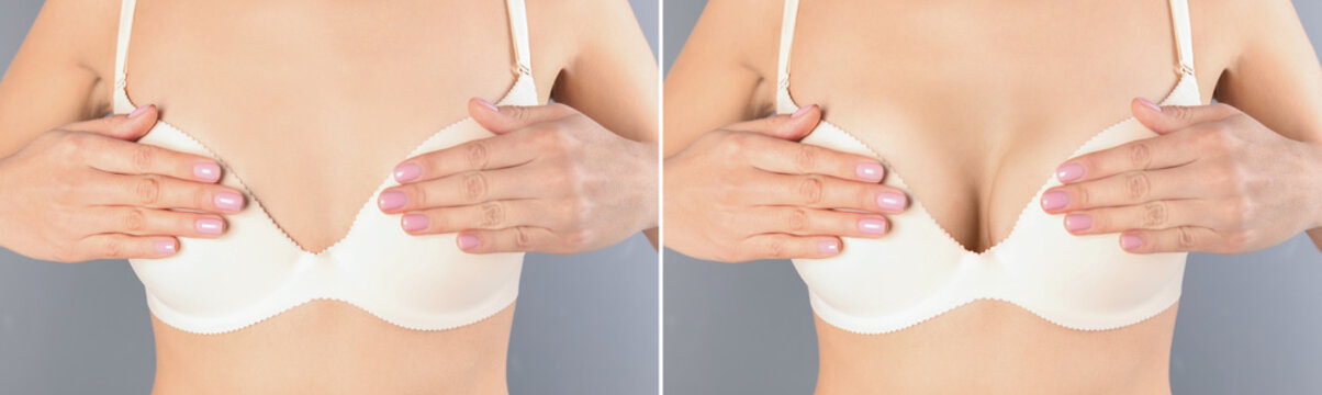 Breast augmentation with silicone implants. Collage with photos of woman before and after plastic surgery against grey background, closeup