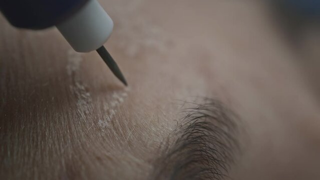 Woman at the doctor dermatologist. The beautician smoothes forehead wrinkles using cryoplasma and argon coagulation. Plasma lifting and facelift. Anti aging treatments. Exfoliate the skin