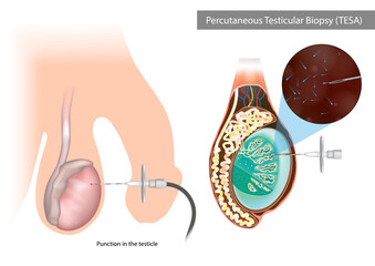 Percutaneous Testicular Biopsy or TESA. Punction in the testicle. Surgical Sperm Retrieval