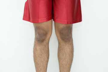 Asian man standing showing dark knee skin