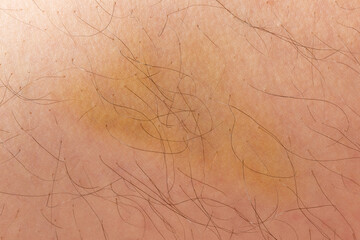 Hematoma on human skin