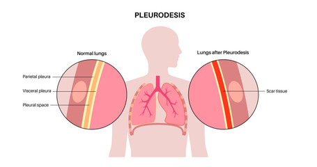 Fototapeta premium Pleurodesis medical procedure Generative AI