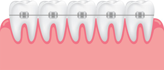 teeth braces illustration. Dental care teeth concept.