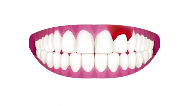 健康な歯ぐきが腫れる症状のイラスト動画