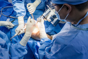 Team of doctor or surgeon in blue gown inside operating room in hospital.Surgeon did total knee joint replacement surgery technology.Osteotomy with medical saw at orthopedic unit.Light background. - obrazy, fototapety, plakaty