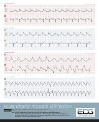 One patient with acute extensive anterior and inferior myocardial infarction developed two forms of QRS complex, followed by ventricular tachycardia.
