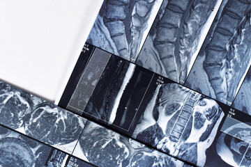 Copy of magnetic resonance imaging of human spine