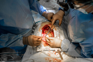 Cardiac surgery. Heart transplantation. Open heart surgery. Surgical instruments. Surgeon at work...