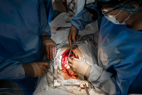 Close up of open heart surgery cardiopulmonary bypass, minimal invasive cardiac surgery, cannulation techniques. Minimally invasive mitral surgery through mini-thoracotomy with cannula. artery shunt