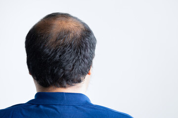 Rear side of middle aged asian man with early stage baldness and hair loss problem