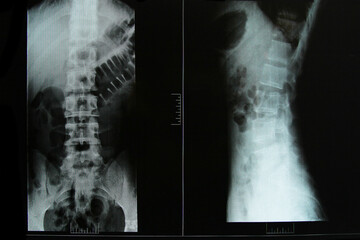 X-ray spine concept health people