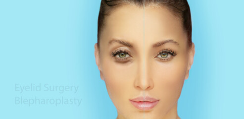 Lower and upper Blepharoplasty.plastic surgery concept.