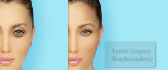 Lower and upper Blepharoplasty.plastic surgery concept.