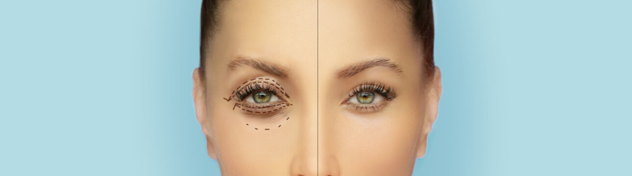 Lower and upper  Blepharoplasty.Marking the face.Perforation lines on females face, plastic surgery concept.