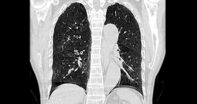CT Chest or CT Scan of  Lung with lung filter for diagnosis TB,tuberculosis and coronavirus or covid-19 .
