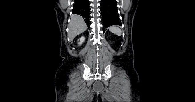CT whole abdomen with contrast media for diagnosis chest and  abdominal pain.