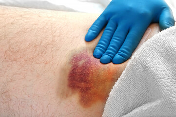 Hematoma on a men's leg close-up. Huge bruise on the leg of a man after endovascular repair due to...