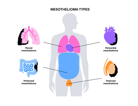 Mesothelioma tumor types Generative AI