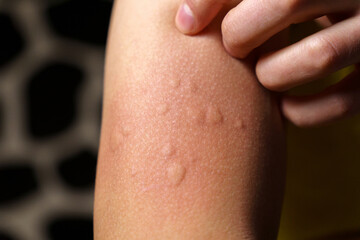 Skin texture, allergy shot, weeds, reaction. Allergy symptoms. Selective focus