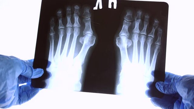 Doctor hands with blue medical x ray scan of feet and toes with Hallux Valgus deformity close up