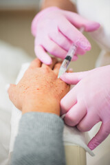 Filler injection procedure under the skin of a woman to combat age-related skin aging - rejuvenating effect