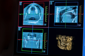 scanning of teeth on an X-ray image of a patient's jaw on a computer screen scaling of the...