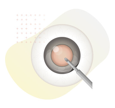 Human Eye - Cataract Procedure - Illustration