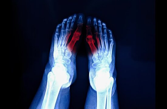 Film x-ray foot radiograph show pain area with red, isolated on dark background. Shoe wearing and cosmetic problems.