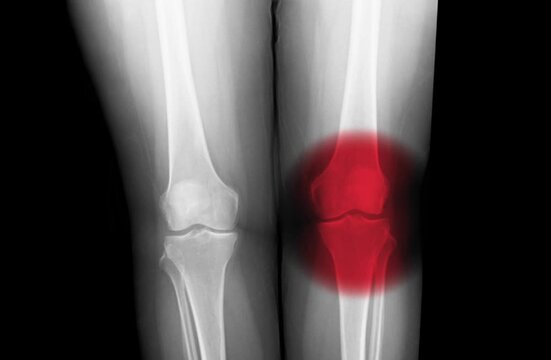 x-ray knee joint show OA knee and pain in joint