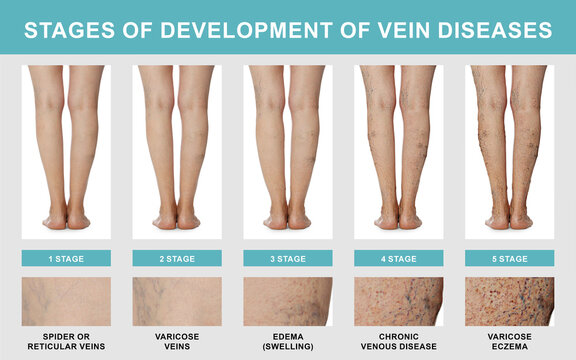 Stages of development of vein diseases. Photos of woman and zoomed skin area, closeup. Collage design showing varicose veins, edema and other phases