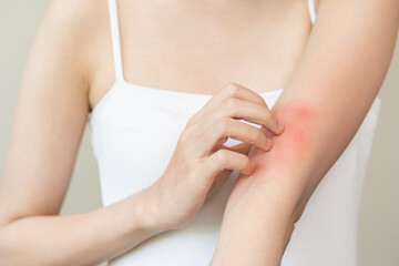 Dermatology asian young woman, girl allergy, allergic reaction from atopic, insect bites on her arm, hand in scratching itchy, itch red spot or rash of skin. Healthcare, treatment of beauty.