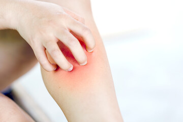 A woman scratching her itchy leg from an insect bite or having allergies. Health care concept.