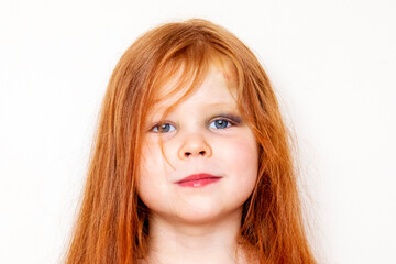 a little red-haired girl with a black eye and a bump on her forehead. head injury