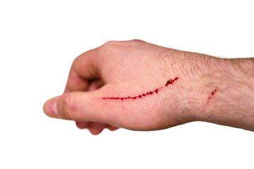 A scratch with blood running down the man arm from a cat, isolated on a white background
