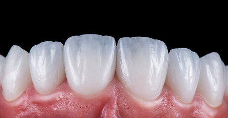 max crowns and veneers