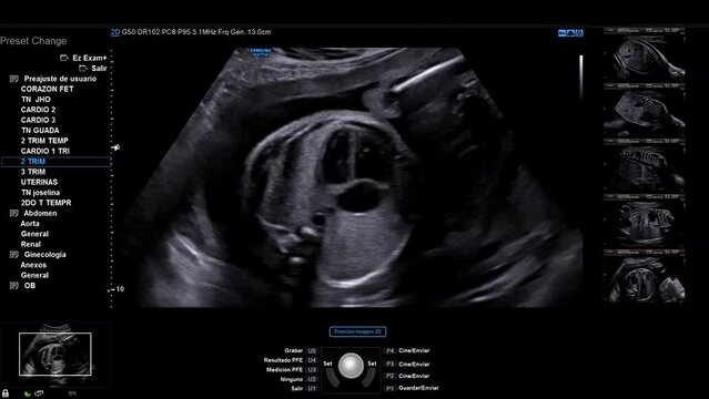 Ecografia de un bebe en gestacion en donde se observa su corazon latiendo, con las palabras del sistema del aparato ecografo en espa&ntilde;ol