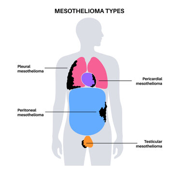 Mesothelioma tumor types Generative AI