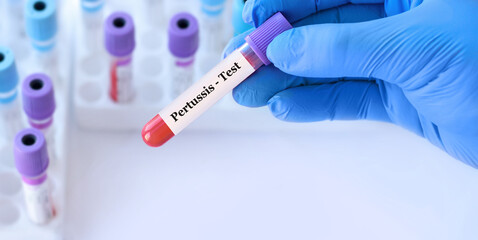 Doctor's hand holds test tube in blood on the background of test tubes with analyzes.Blood sample with pertussis testing.